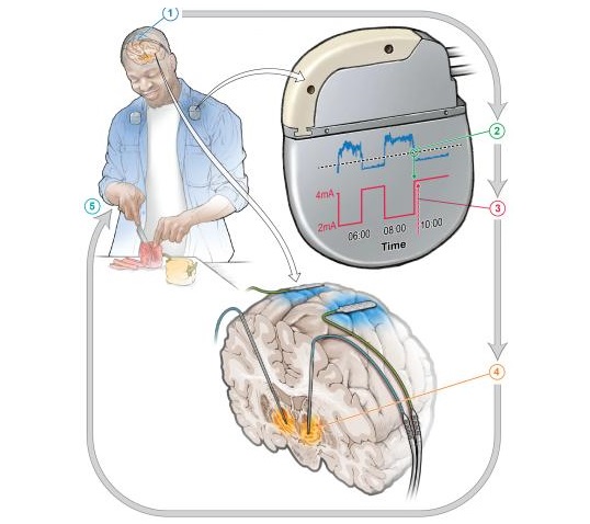 Imagen: El dispositivo implantado responde a los cambios en las señales cerebrales, ajustando la cantidad de estimulación durante todo el día (Foto cortesía de Phillp Starr Lab)